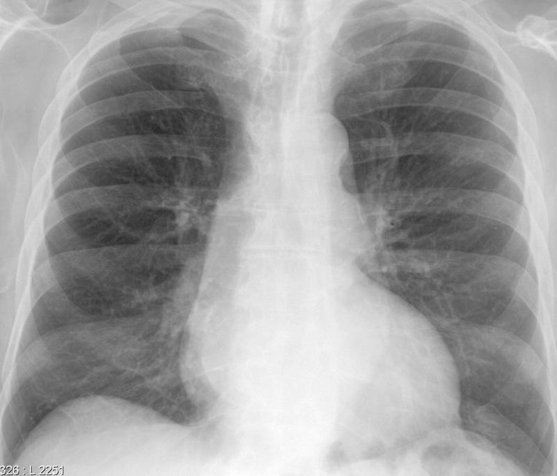 Calc Ao valve & LtA