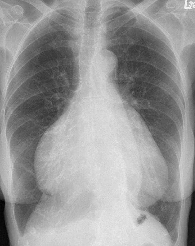 Cardiomegaly, esp RA PA