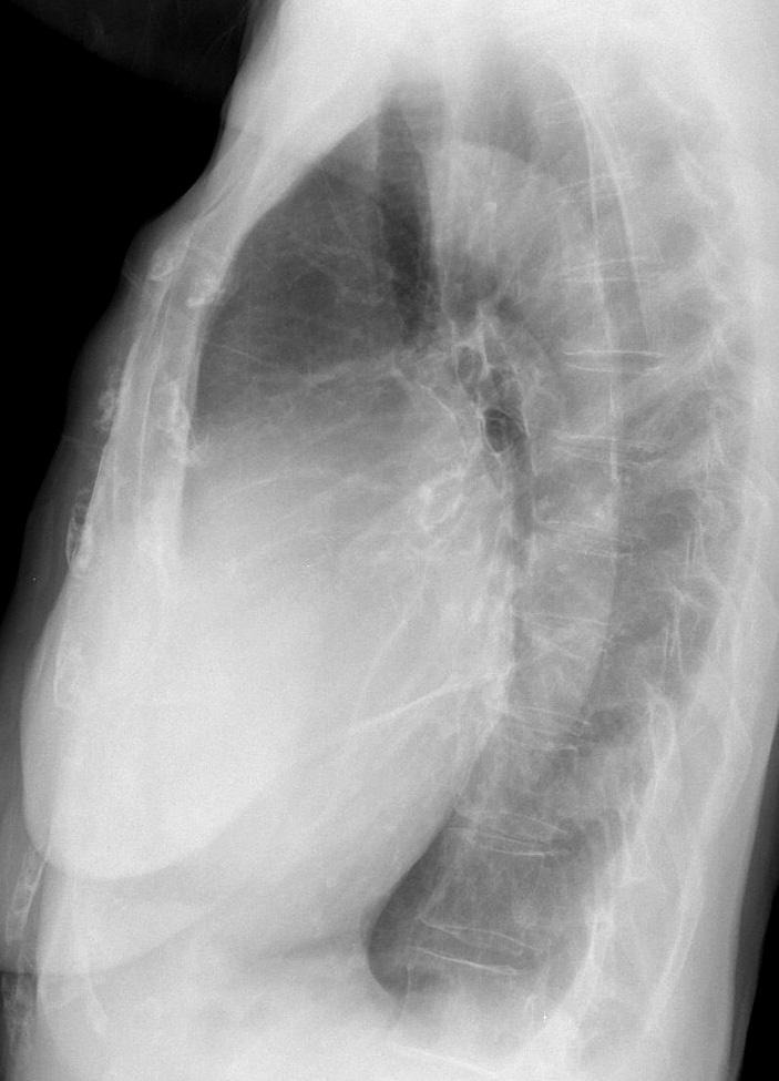 Cardiomegaly, esp RA Lat