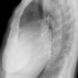 Cardiomegaly, esp RA Lat