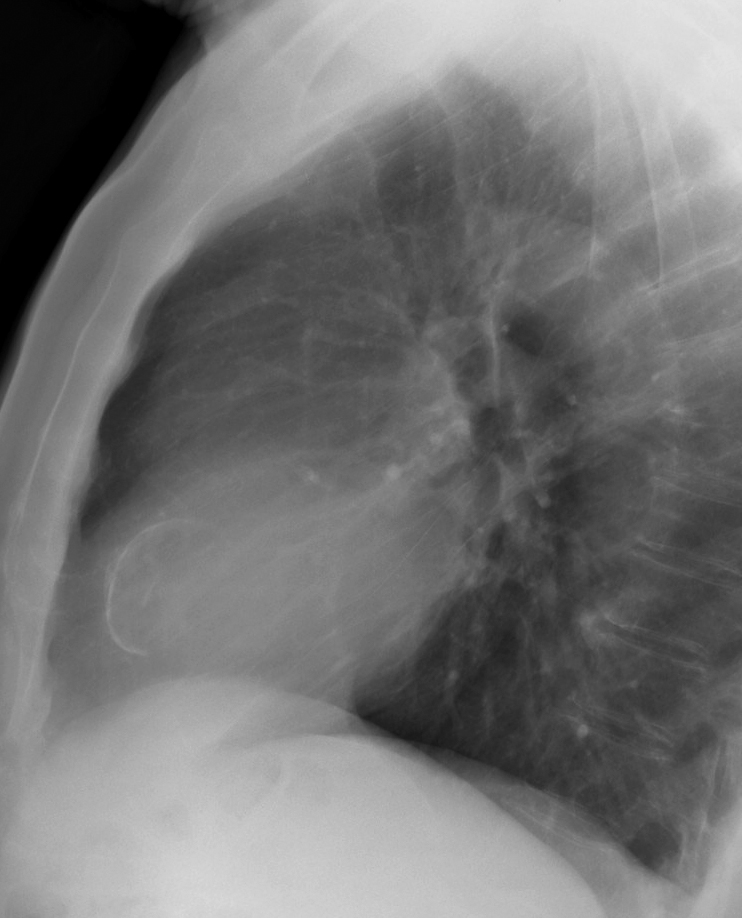 LV calcific lat