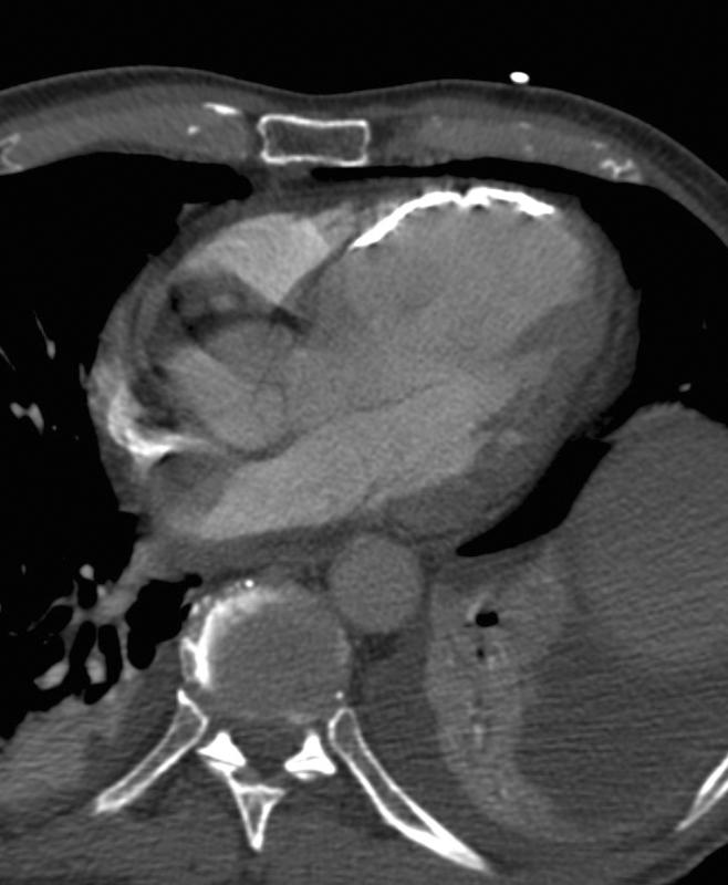 LV ant wall calcif