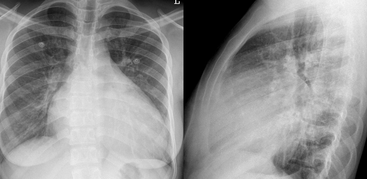 Cardiomyopathy2