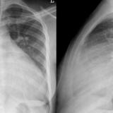 Cardiomyopathy2