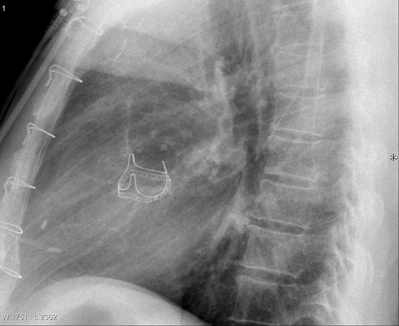 Ao tissue valve (lat only