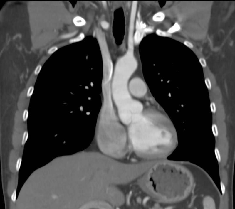 coronal CT