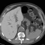 Amiodarone liver