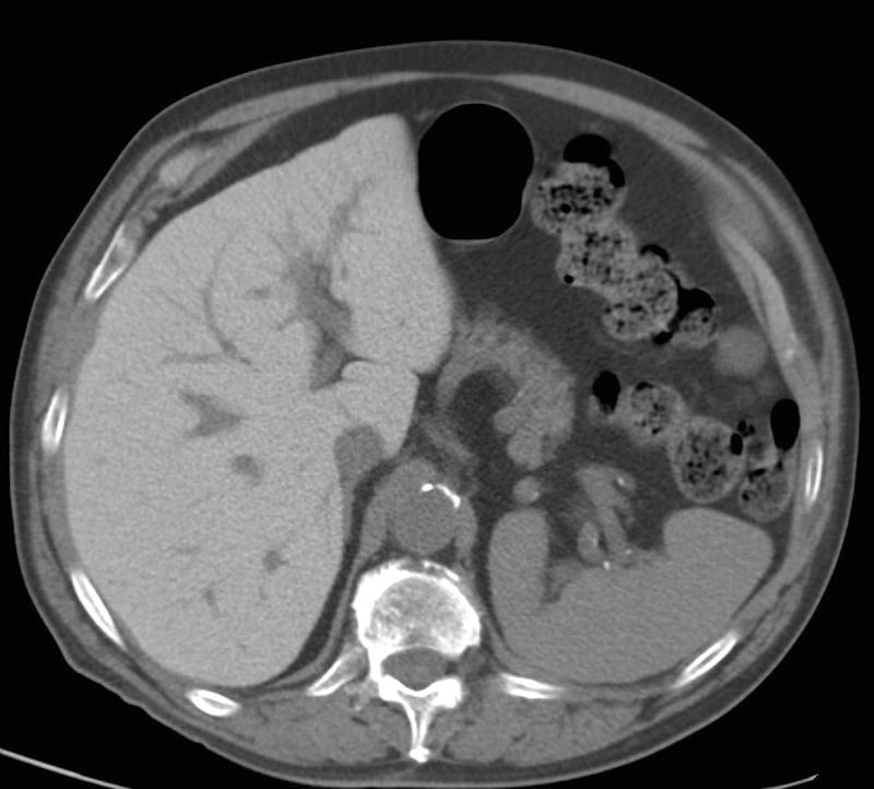 Amiodarone liver