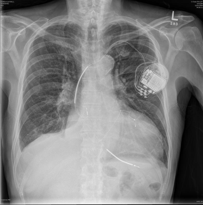 Biventricular ICD