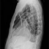 Biventricular ICD lat