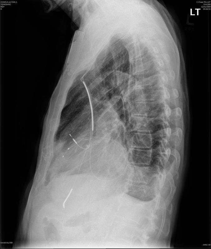 Biventricular ICD lat