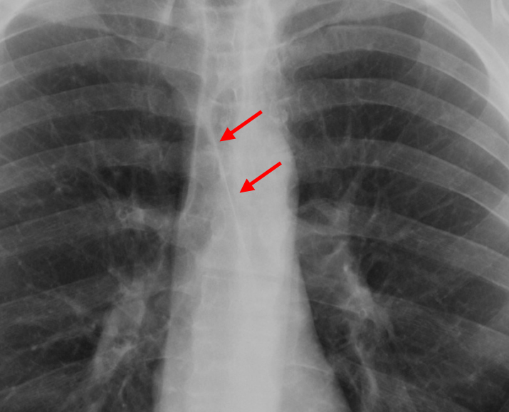 Anterior junction line