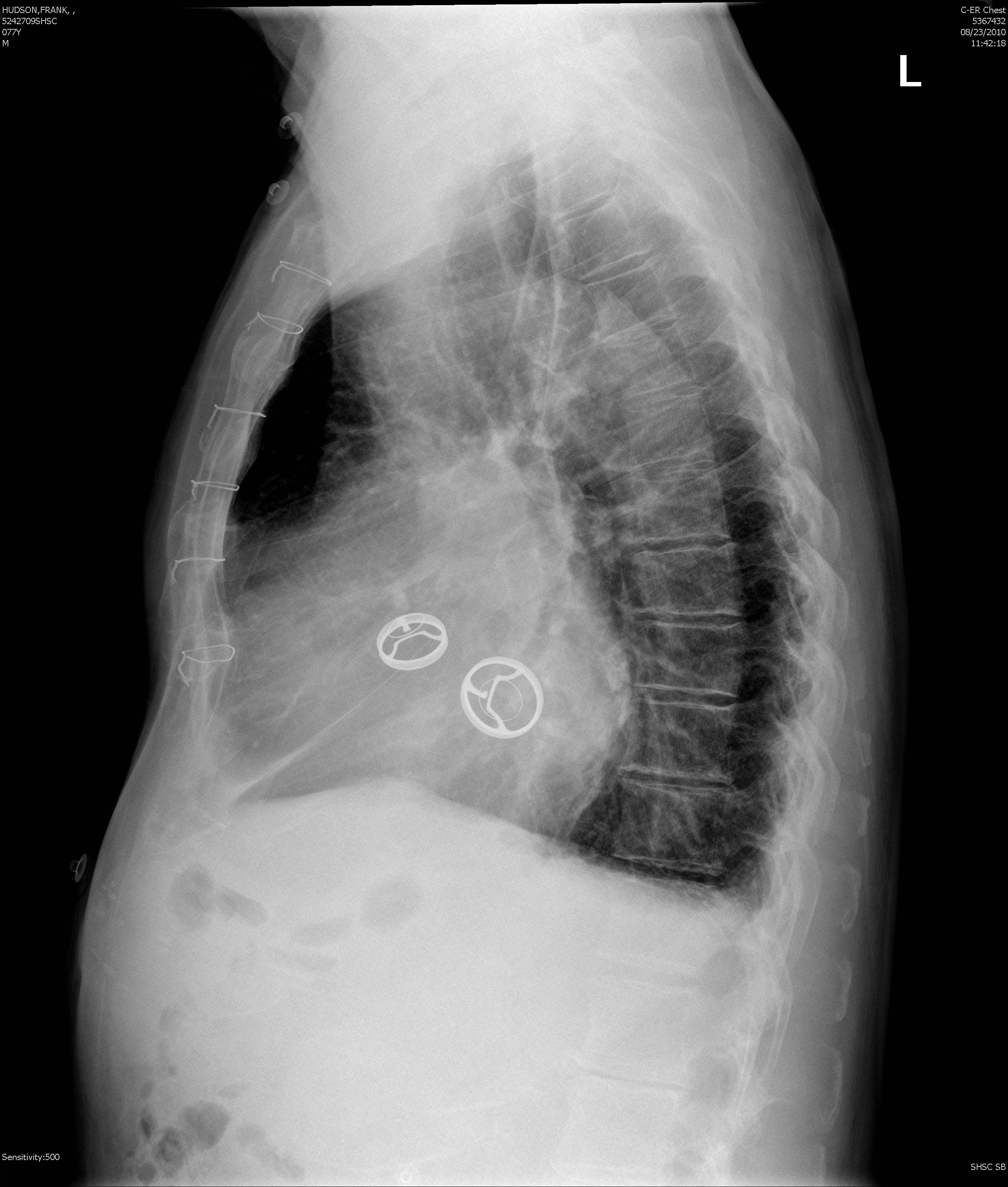 prosthetic valves lat