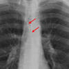 Anterior junction line