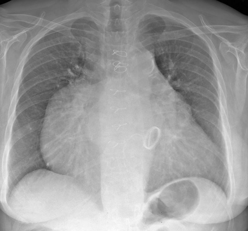 Giant Rt Atrium
Post Mitral and Tricuspid surgry