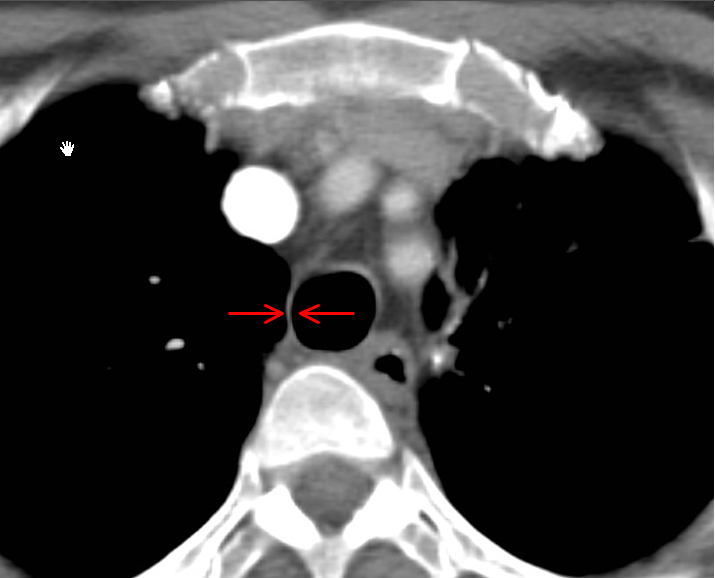 Paratracheal stripe