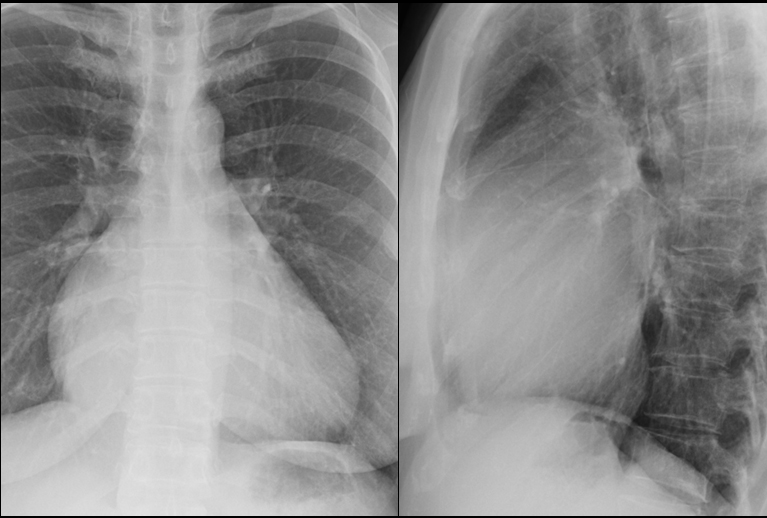 Tricuspid insufficiency