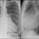 Tricuspid insufficiency