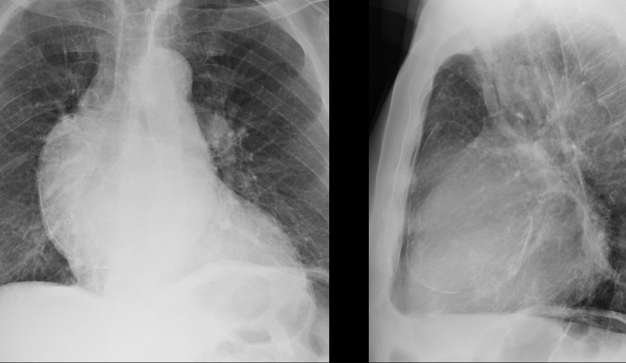 Aortic aneurysm