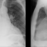 Aortic aneurysm