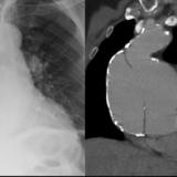 Aortic aneurysm