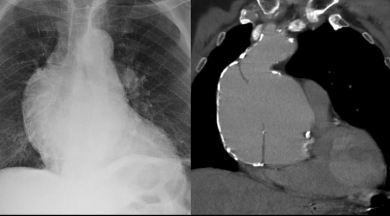 Aortic aneurysm