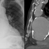 Aortic aneurysm withl ateral