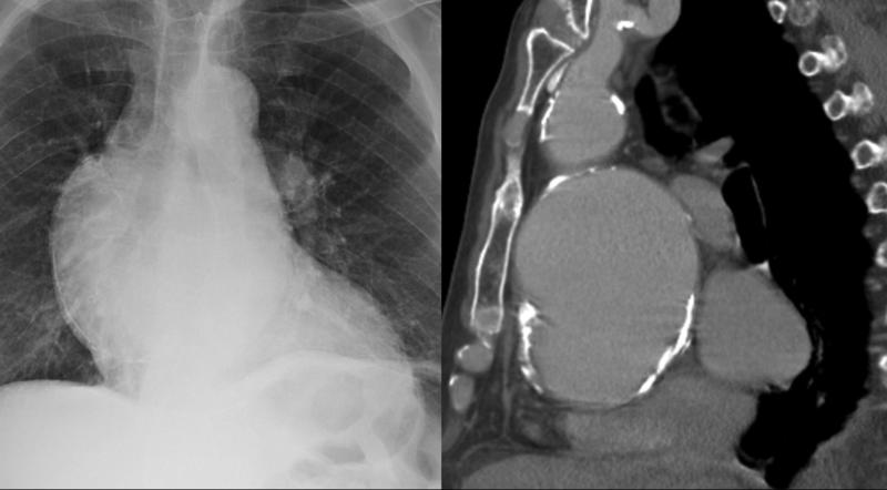 Aortic aneurysm withl ateral