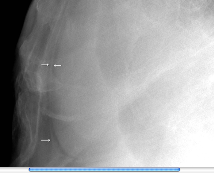 Pericardial stripe