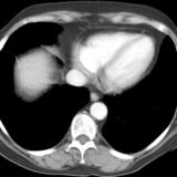 Normal pericardium