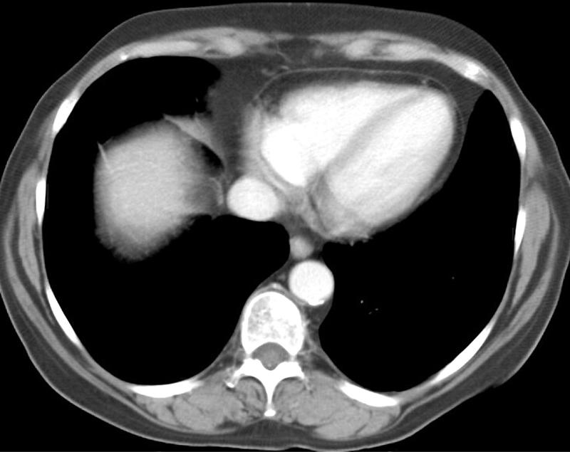 Normal pericardium