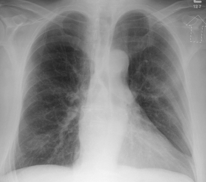 Case 1 PA 
Peric calcification