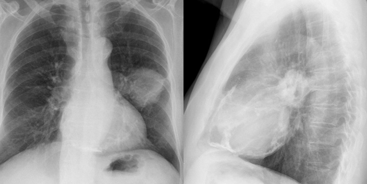 Case 2  Lung cancer and
Peric calcification 
