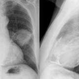 Case 2  Lung cancer and
Peric calcification 