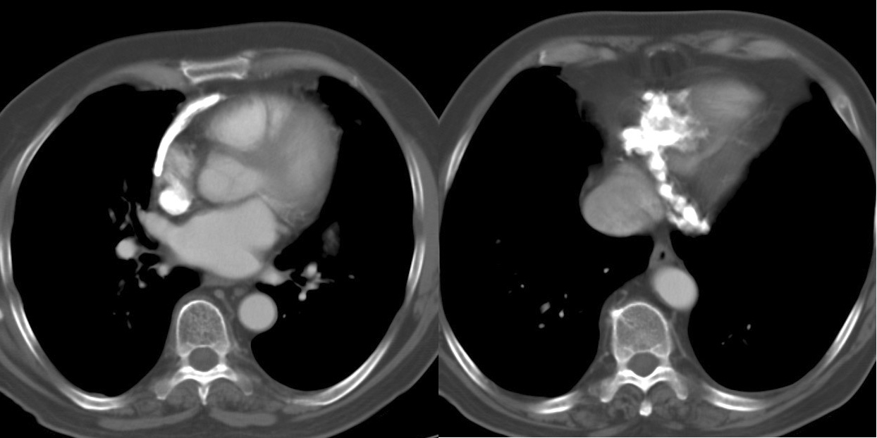 Case 2
Peric calcification