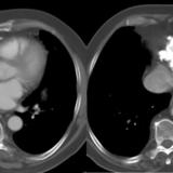 Case 2
Peric calcification