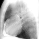 Case 3 Lat only
Peric calcification