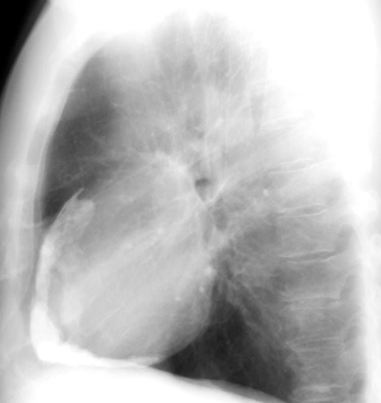 Case 3 Lat only
Peric calcification