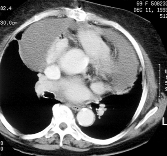 Case 4b
Peric effusion