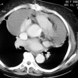 Case 4b
Peric effusion