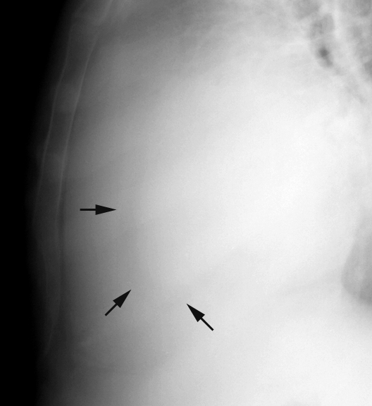 Case 6c
Peric effusion c/u