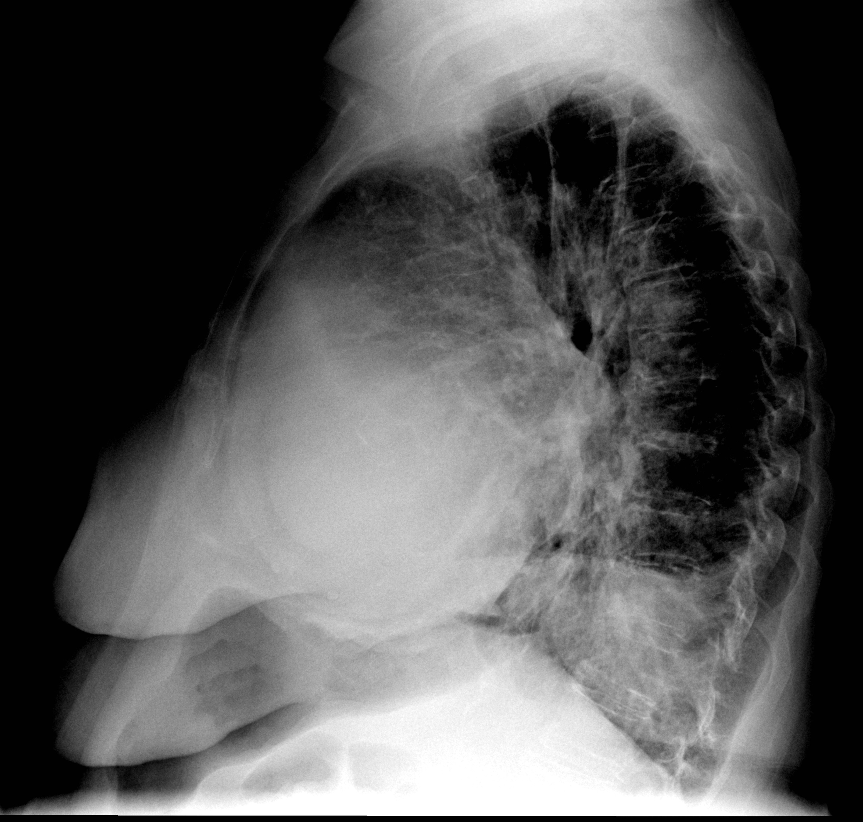 Case 7b
Peric effusion