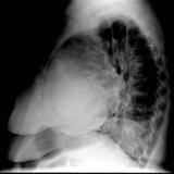 Case 7b
Peric effusion