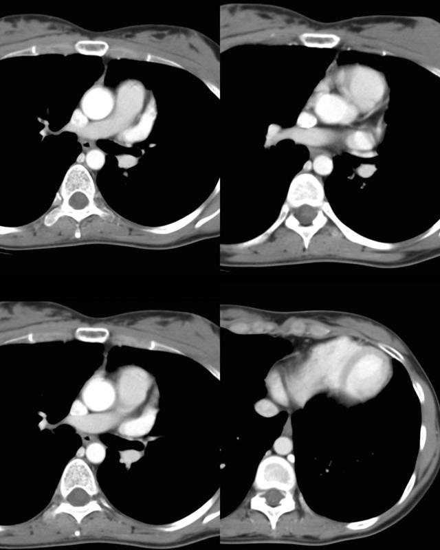 Part'l absc peric CT