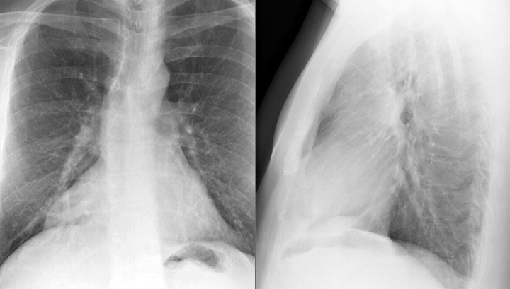 Periccyst Case 1