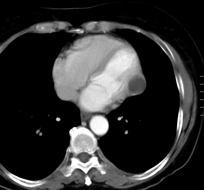 Peric cyst Case 2