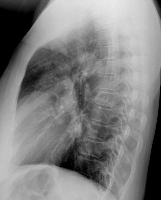 Peric cyst Case 4