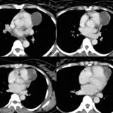 Peric cyst Case 4