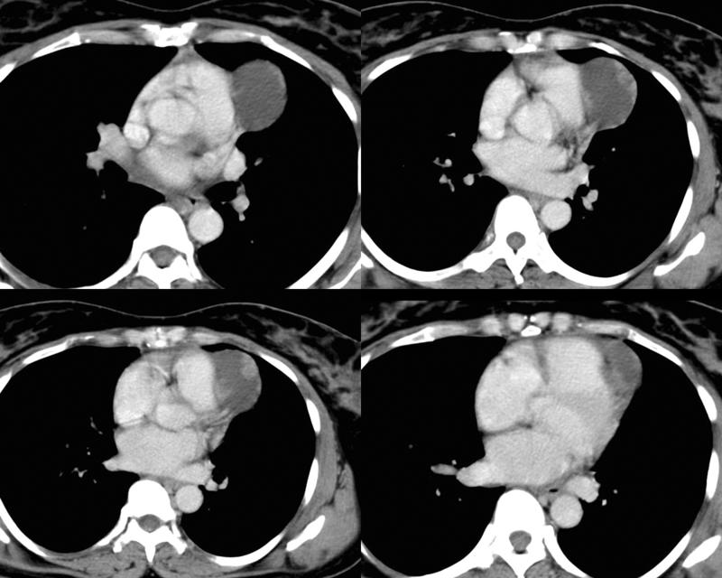 Peric cyst Case 4