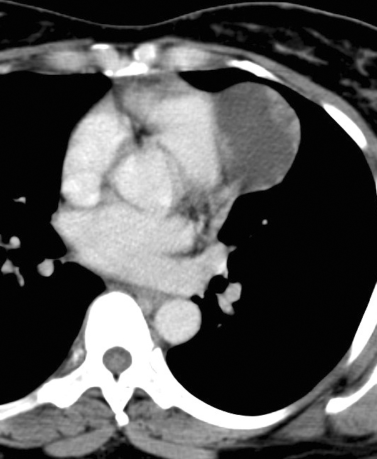 Peric cyst Case 4